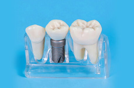 Choosing the Right Dentist for Your Tooth Crown Procedure