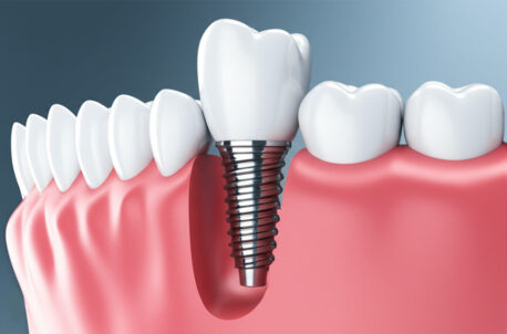 Should There Be a Gap Between Gum and Implant? What You Need to Know